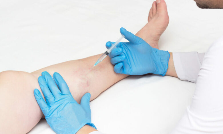 vein ablation procedure