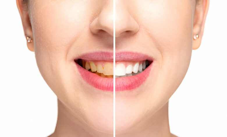 Teeth Whitening in Aberdeen