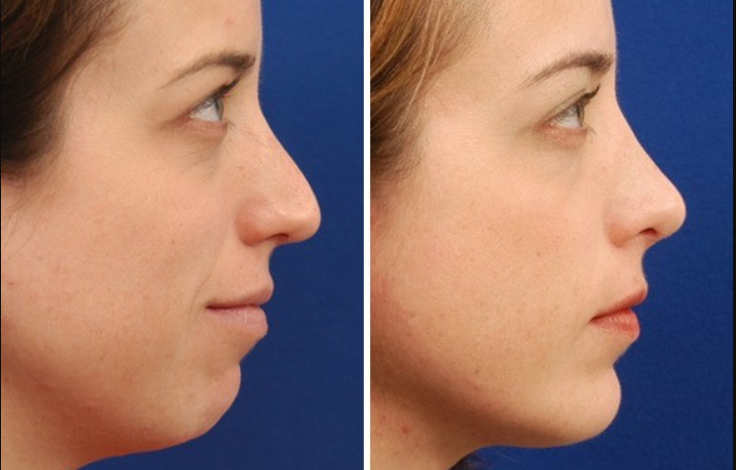 chin aggumentation