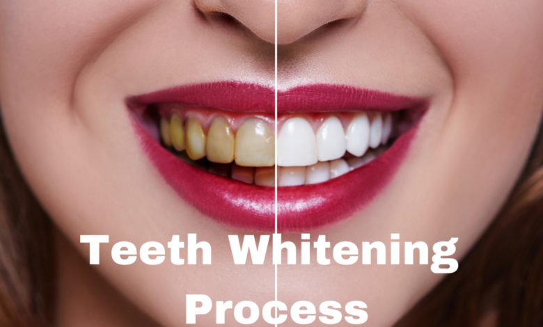 Teeth whitening services in Flagstaff, AZ