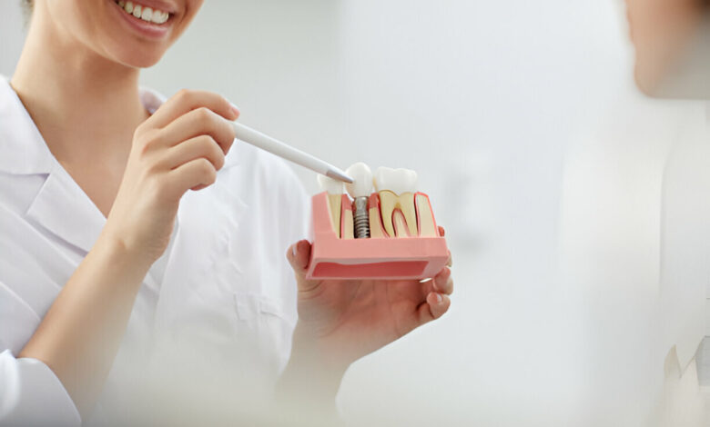 What to Expect: The Dental Implant Process Explained