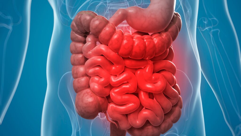 Managing Diverticulitis