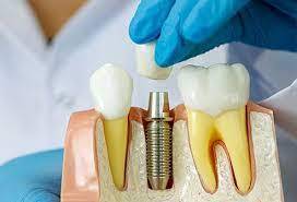 Dental Implants: The Ultimate Solution for Missing Teeth