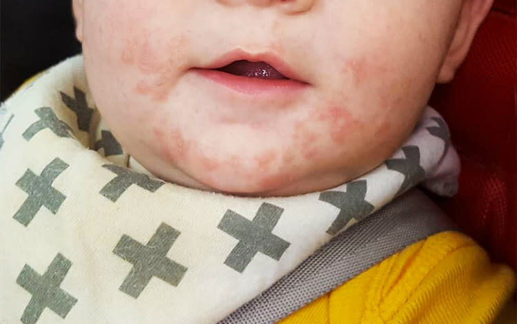 distinguishing drool rash from eczema