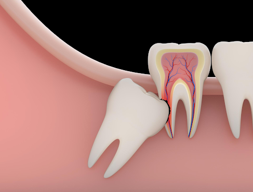 impacted wisdom tooth