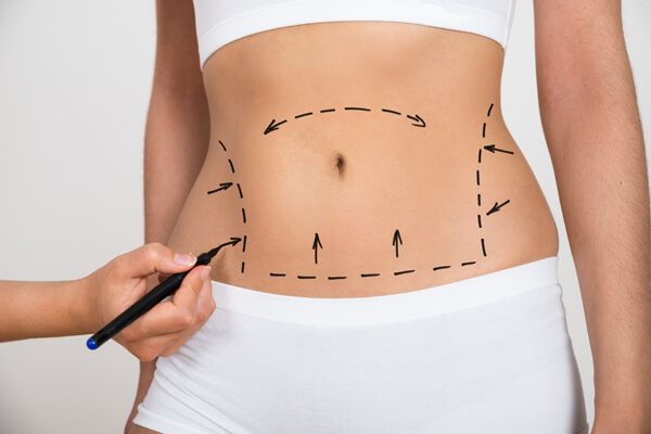 liposuction in Dubai