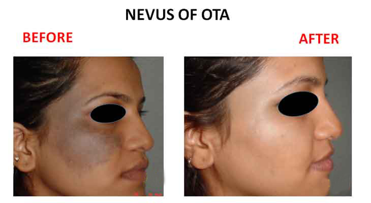 Nevus of Ota birthmark removal