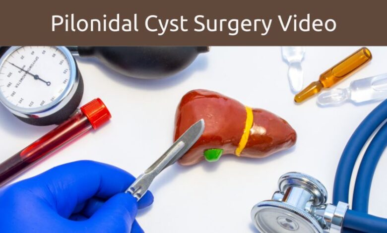 pilonidal cyst surgery video