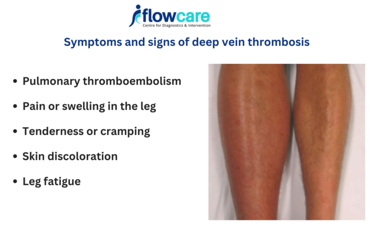deep vein thrombosis symptoms