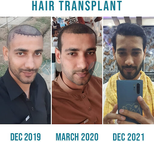 best hair transplant in lahore