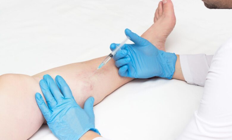 How Much Does Varicose Vein Treatment Cost