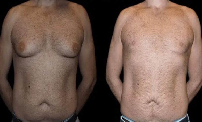 Before and after male breast reduction results